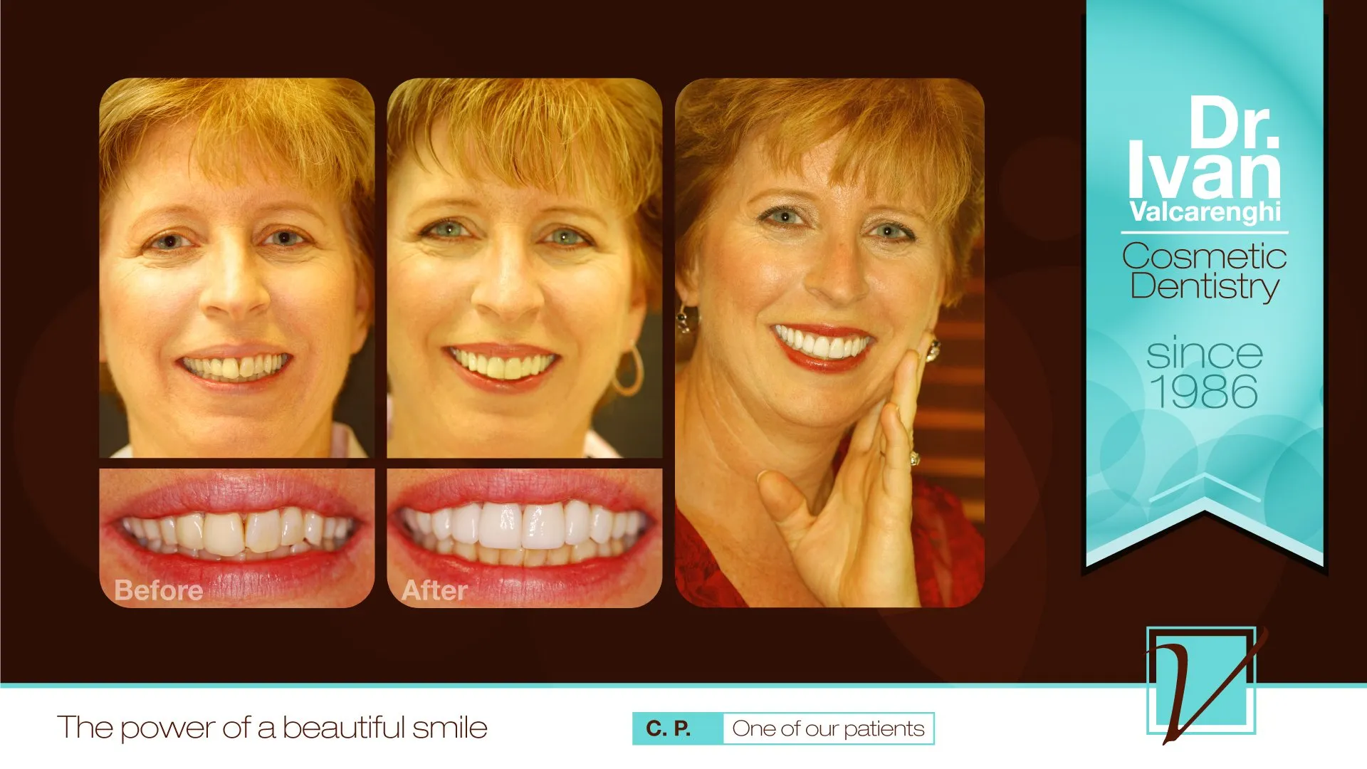 Cheryl - As Cheryl approached a milestone birthday, her desire was to have a more youthful and attractive smile that also reflects her success as an entrepreneur. Cheryl’s smile didn’t look bad, it just lacked that “pop!”