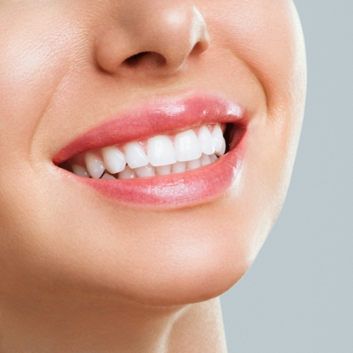 Smile Makeover