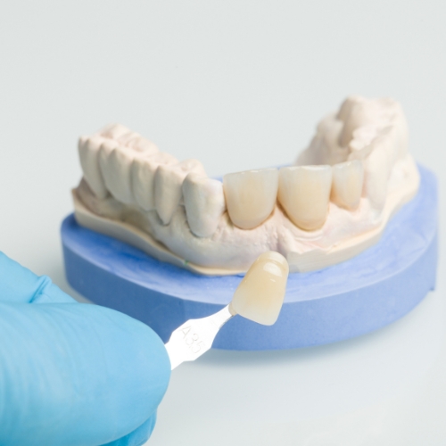 Veneers