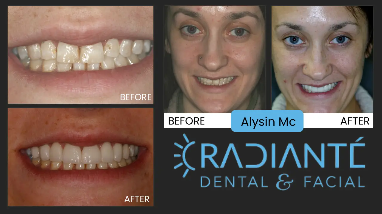 This is AlLyson.  She is very shy and was sooo nervous for her photoshoot, but doesn't she look fabulous!  

What she wanted: To be able to Smile without covering her mouth. Allyson inherited mottled enamel in her teeth which is sometimes called "soft" teeth ,and results in frequent cavities .   We can perform treatment that actually protects her teeth and actually makes her teeth stronger, beautiful and natural. 

What we did:  It looks simpler than it is, starting with eliminating the cavities. We got her working better at home and reviewing her diet.  We then removed all the damaged tooth structure , replaced and rebuilt her teeth. Her gums were then gently reshaped with laser gum surgery ,or a "Gum Lift" , which  makes a  more  balanced  and symmetric  smile. Finally, Veneers - creating the  beautiful , natural smile Allyson wanted to share with the world.

"What a difference it has made in my life!"  --Allyson M.--