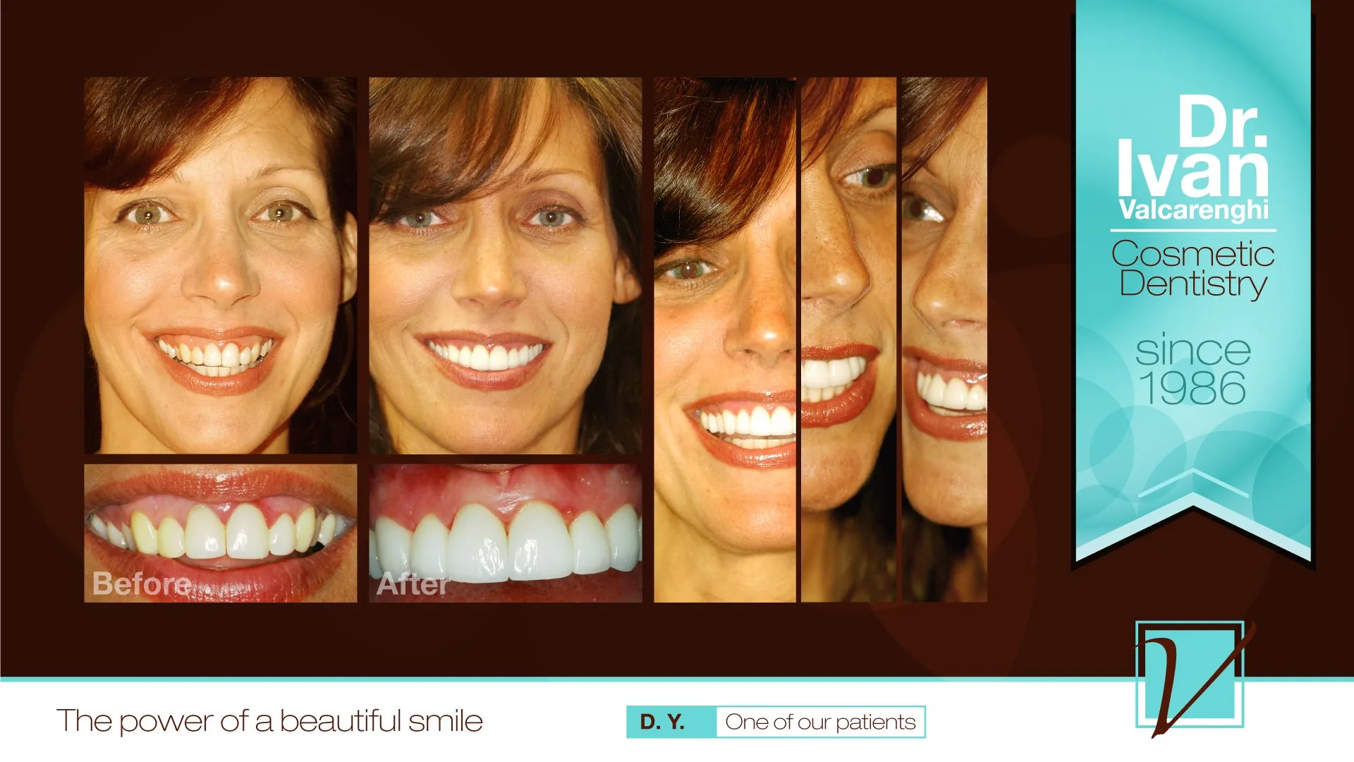 Deey - Dee had  veneers done many years ago for her wedding, before  many of the advancements in materials and techniques  could insure a natural look. As her husband's career progressed, Dee  found that her smile wasn't holding up and Dee was self-conscious.