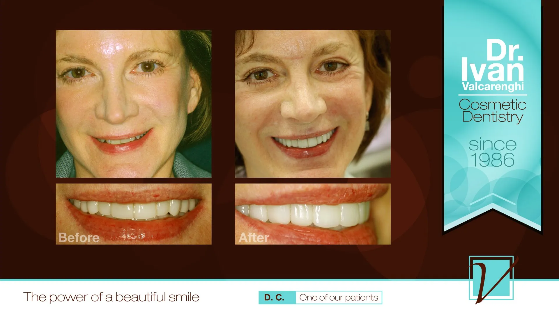 Donna - We brought back Donna's smile to a fuller, more youthful, sexiness and elegance to the smile. Now that's something new...your teeth can make you sexier and more elegant?  Absolutely!  Just look at how great Donna now looks not to mention how she feels!
