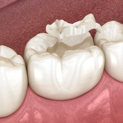 Fillings