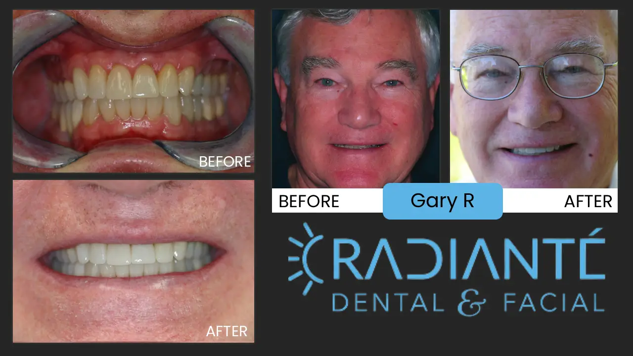 Gary is one of the nicest guys you would ever meet. Gary had a terrible clicking (actually clunking) in the jaws and headaches. He was hoping to find a solution to correct the jaws and was surprised that a solution could exist for his headaches.
As a former aviation manager, he never had the time to do anything about the terrible popping and clicking in his jaws caused by the stress of work and years of clenching and grinding his teeth.

What We Found: Where are Gary's teeth when he smiles? Discolored worn out, mishmash of different types and colors of the teeth you can see. A cosmetic dentist will look at Gary as a whole,at the symmentry of Gary's face, you would notice that the lower one-third of Gary's face is far shorter than the middle or upper 1/3. His nose-to-chin ratio is very short. There is quite a lot of stress on the TMJ or jaw joints causing them to wear and degrade prematurely and could lead to disabling arthritis in the jaw joints.  This explains the terrible jaw noises when opening and closing.

What We Did: Because of Gary's bite and jaw issues, Full Mouth Rehabilitation was needed that would alleviate the pressure on his TMJ and jaws, improve his bite and give him newer, healthier, more uniform looking teeth as well as showing the teeth when he smiles.   

A great side effect enjoyed here is jaws, TMJ and headaches gone anf gary is feeling great. 

We are very happy to have helped Gary.  It's been several years and he's doing great and still racing cars!