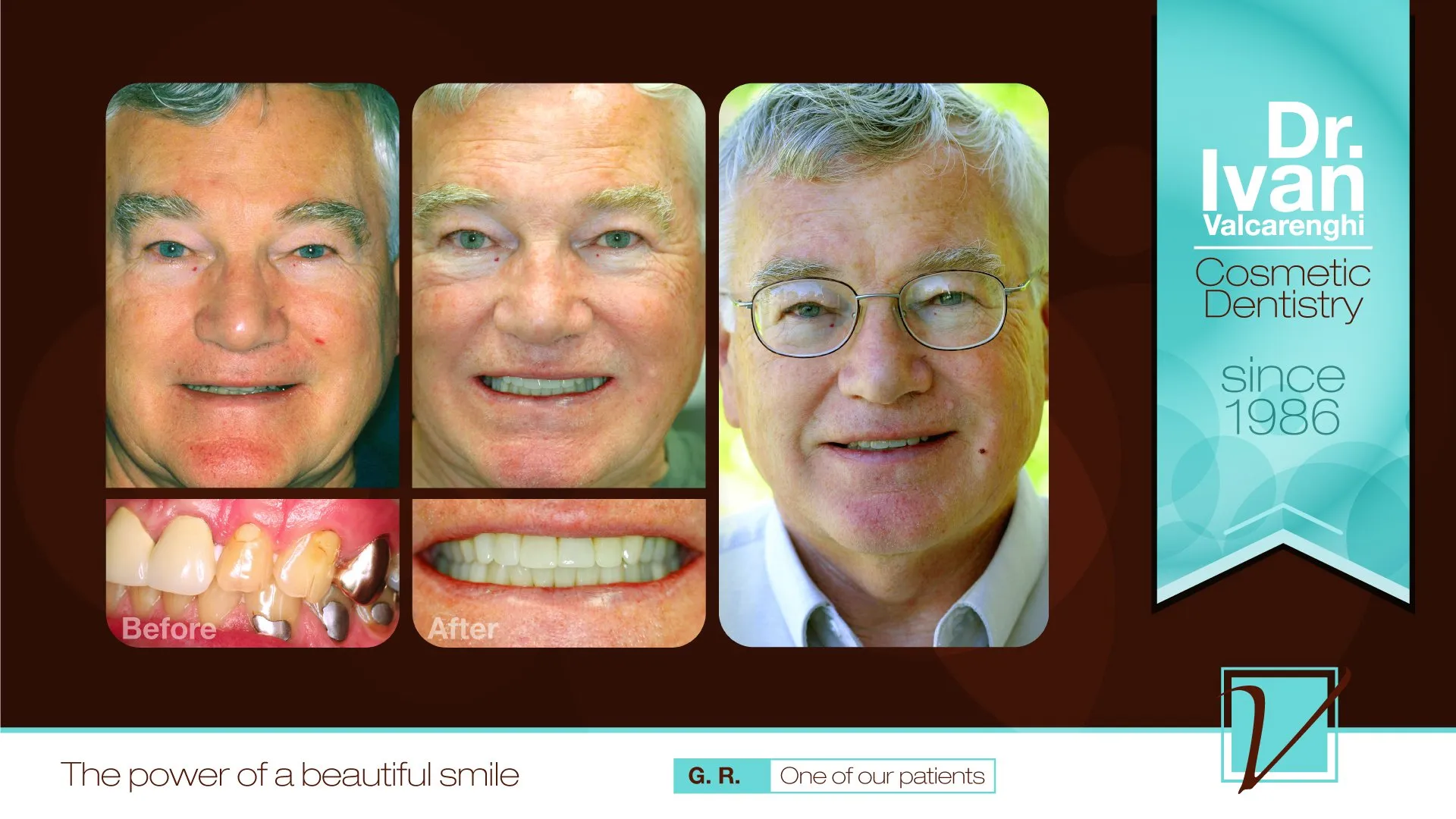Gary - Gary is one of the nicest guys you would ever meet. Gary had a terrible clicking (actually clunking) in the jaws and headaches. He was hoping to find a solution to correct the jaws and was surprised that a solution could exist for his headaches.