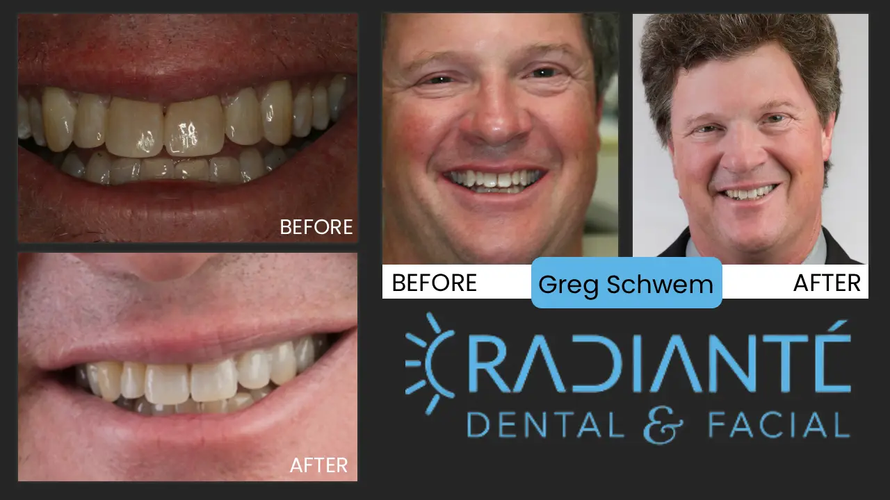 Greg is an author of "Text Me!", executive and corporate speaker and entertainer.

He felt self-conscious about his irregular smile with his "fangs" and gaps.

We did a combination of small, but effective treatments including bonding and recontouring to give him a smile that is more contiguous.  He is very satisfied and has even done commercials for Dr. Ivan to thank him for his "mini smile-makeover!" Greg and his wife Sue are now both on our "Wall Of Fame!"