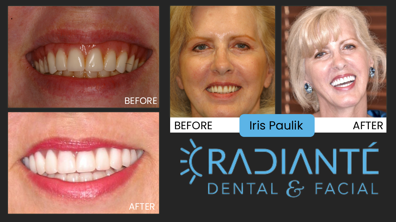 Iris is beautiful, but she just wasn't happy with the smile a dentist had recently made for her.  After listening to her desires, Dr. Ivan found that Iris was unhappy with how gummy her smile looked.

What Dr. Ivan found:  all too common in orthodontics as well, dentists try to align the upper and lower teeth together to make them look straight.  The problem is that Iris has an overbite and by aligning her upper and lower teeth together creates the gumminess.

As with most overbites, it's not the upper teeth that are the problem, it's the lower jaw that doesn't develop far enough forward.

What we did:  In creating this full mouth rehabilitation, Dr. Ivan first created the ideal upper teeth to where Iris was very excited about the aesthetics.  He then designed her lower teeth to meet this idealized look and voila!  An excited and beautiful smile for a beautiful woman!