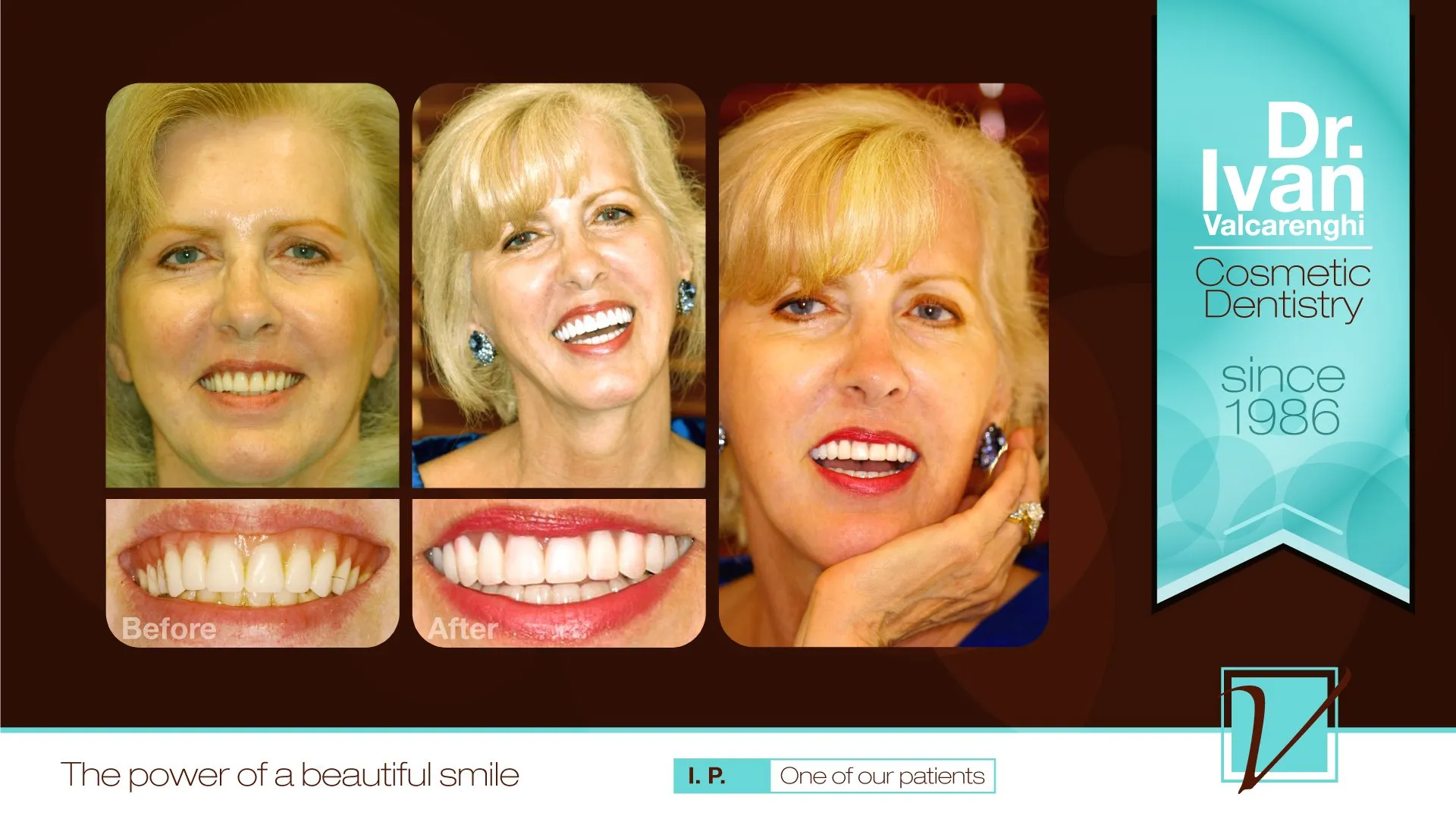 Iris - Iris is beautiful, but she just wasn't happy with the smile a dentist had recently made for her.  After listening to her desires, Dr. Ivan found that Iris was unhappy with how gummy her smile looked.
