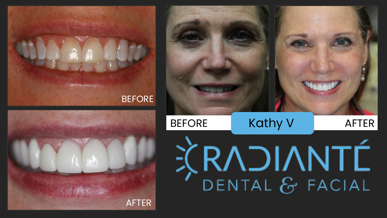 Our own Kathy who had the greatest looking smile and teeth for the longest time, alas, it was time to give her a fresh look.  After attending the wedding of one of our clients, she looked at the photos of the bride and her together and said it's not fair our clients have nicer teeth than me!  She was of course absolutely right. She had wanted veneers for a long time, but being always very conservative Dr. Ivan always felt Kathy's teeth were very attractive and didn't want to mess with a good thing. He now agreed with Kathy. This is on the day of delivery. Later we did her photoshoot of course. A beautiful woman like Kathy deserved a smile to match!