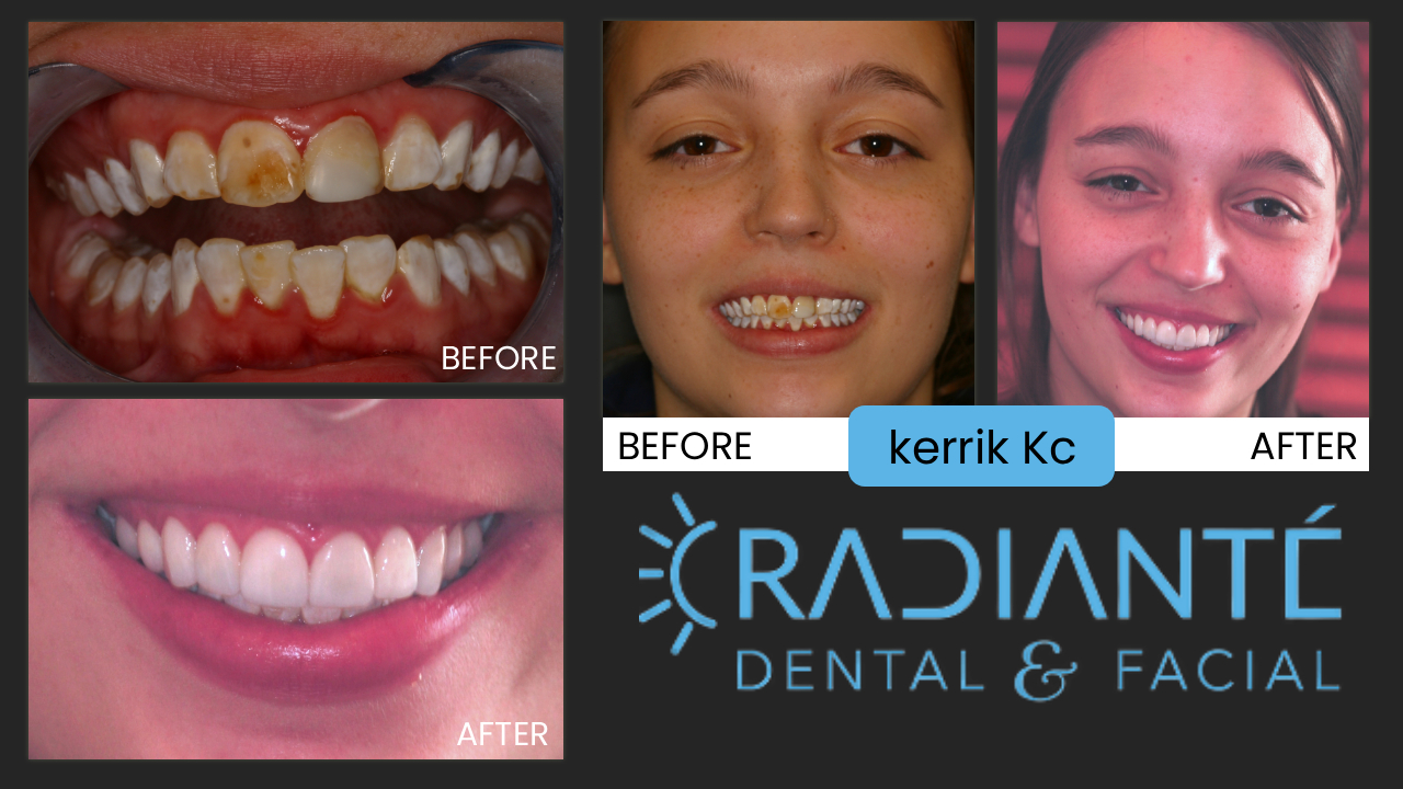Kerri's story is heartbreaking and heartwarming at the same time.  From difficult, dysfunctional parents, Kerri's grandfather took on the mantle of making sure Kerri was on a better path in life and when he asked her what she wanted for her 18th  birthday and graduation gift from high school, without hesitation, she said "I want my teeth done." With lack of professional
care imagine how aweful it would be for a young lady to have front teeth and a smile that is marred and unattractive.  You
don't want to smile when your teeth look like the "before" photo.  Imagine how she felt. Imagine the teasing she received in
middle school when kids can be a careless with their comments.  A few visits later, a young woman blossomed before our very eyes. You could see the transformative effect this made on her immediately.  Kerri is a huge success today having not only
finished college, but also grad school, is a married mother of two and has left that horrible childhood far behind and has
become a beautiful, successful wife and mother.  We are happy to have been a part of helping her look and feel her best, confident to go out in the world with perhaps her best asset representing how beautiful she truly is.