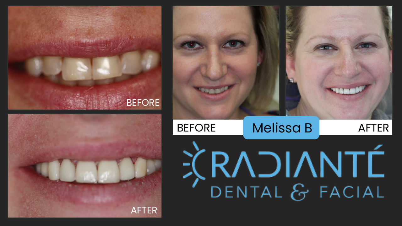 Melissa came to us two years earlier for a consultation about her smile which was neither healthy nor attractive.  She would cover her mouth when she would smile or laugh and was embarassed by the condition her teeth and smile. Waiting two years is not unusual. Lots of people can take a couple of years before they make the decision to do something about their health and smile and Melissa was super motivated when she came back in.  And thank goodness for that because a full mouth rehab is difficult to begin with, and in conjunction with dental implants which can take 6 months alone, it was quite a journey to get to
the beautiful and confident smile she now has achieved. Congrats Melissa, your smile is as beautiful as you are!