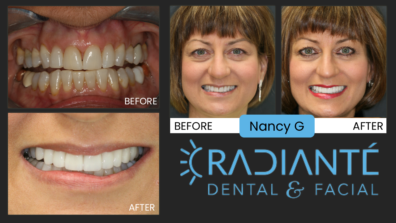 Nancy wanted to take the edge off aging. Nancy's smile looked okay, but okay is not good enough for an attractive lady like Nancy and in her line of work. As a consultant to some of the most advanced cosmetic dentists in the country, Nanci wanted a smile that was healthy and attractive, but she also had some design concerns because she has seen so many smile makeovers she didn't like. 


What we Found: A Great Foundation of Healthy teeth.

What we did: 10 veneers, Beautifully natural that fits Color, shape
and balance. 
 

"Not one dentist at our training seminar knew I got my teeth done!  That's why I chose you Ivan!  I love my smile.  It looks great, yet beautifully natural! "  --Nanci (Blatchford Solutions)