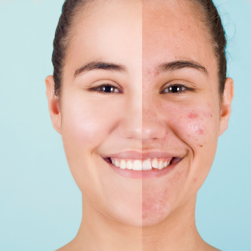 Scar Treatment