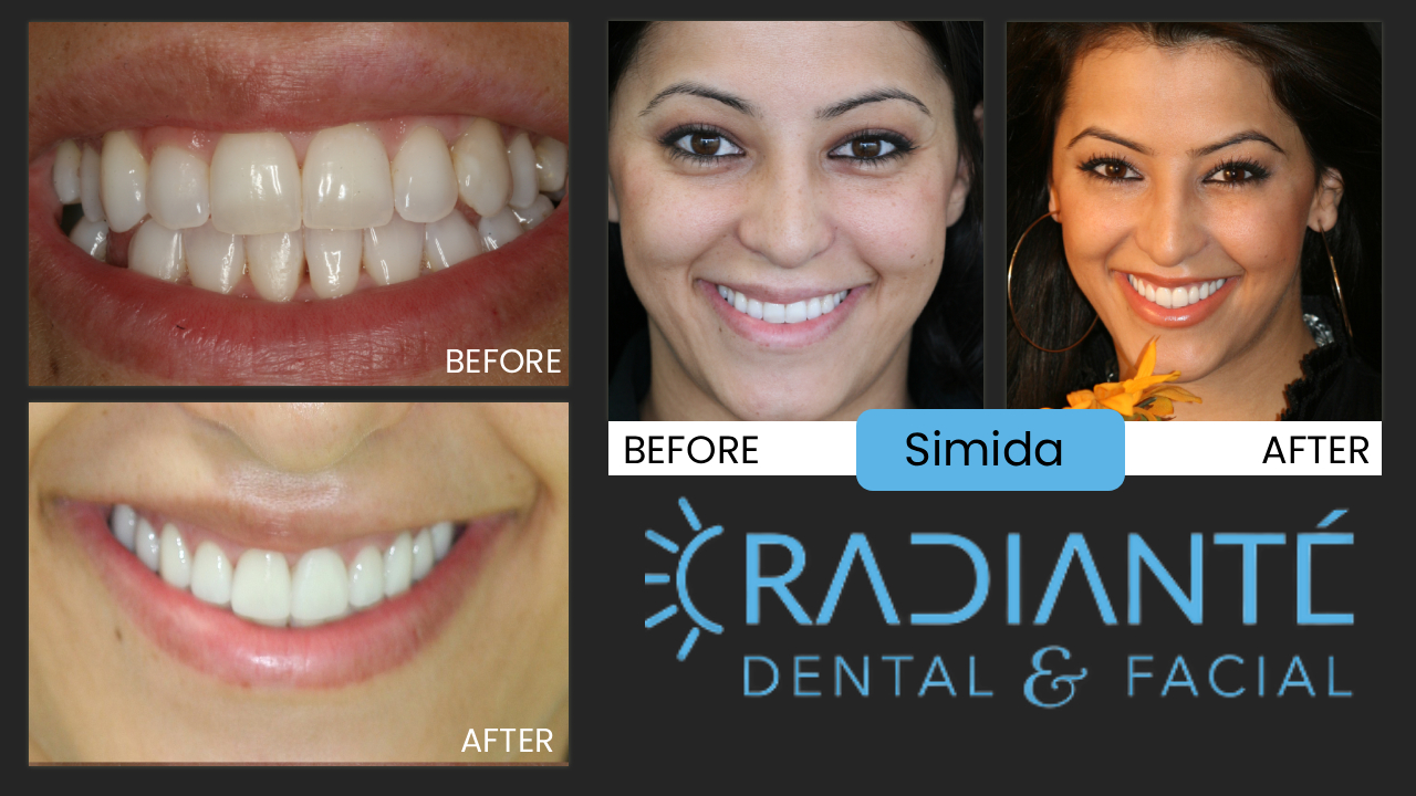 Thanks so much for the beautiful smile!! It is the greatest thing! I tell all my friends about you, but nobody has the money it seems even thou many need HELP :)) I'm still hoping that my cousin from Vegas will decide to do her smile. She is very beautiful and that's why I keep pushing her! You are the only doctor I recommended.


Simida already had a great smile, but she wanted one that lit up a room.  Simida is an interior designer and her eye for art is very descriminating, working with some of the most prominant builders in downtown Chicago. She also knew exactly what she wanted in her smile design, having purchased a smile design book, and bringing many photos to her consultation. 

What We Found: Simida had taken a traditional route of orthodontics, but after a year her teeth had drifted and moved. She wanted a more dependable and better results. 

What we Did: The Whitest Smile Yet. WOW!

Simida was a natural in front of the camera.  Normally we get only a handful of photos we like in a shoot.  We loved over 75% of her photos!  That's a record. 

What a beautiful smile for a remarkable and beautiful lady.  "That's why I chose you, Dr. Ivan...I knew you could give me what I wanted.  I love my smile!  I will refer everyone to you!"  Simida

It is my pleasure, Simida.  You are an amazing lady!