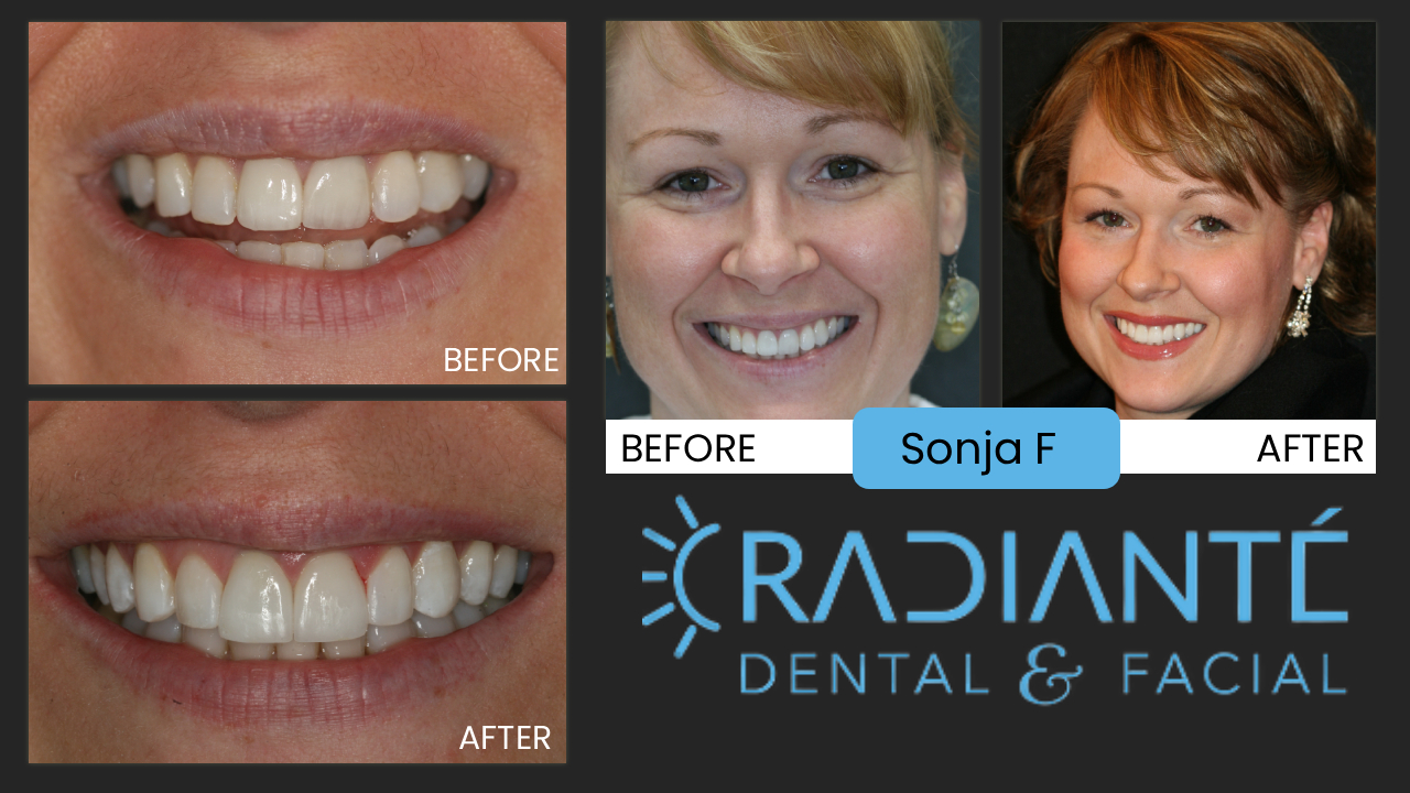 Sonja's story is an example that not all dentists who claim to do cosmetic dentistry, are the same. Sonja worked for a very good dentist on the East Coast, with a the committment to continuing education. Training is great, however, you need an understanding about materials, chroma, translucency, show through, design, and function. All the details that impact the results.

What we Found: Look closely at the "before" photos, Sonja looks okay, however, something is off with the position, and the teeth seem grayish in color. We discovered leakage and a bad smell around the new front teeth. Sonja was experiencing some bite problems and pain. This is a good example of how a dentist cannot just put a veneer and a new crown on front teeth without first understanding materials and the correct bite of the patient. There should not be pain or a smell after treatment.

What we did: New beautifully balanced porcelain restorations on her front teeth. We also did a variety of supportive procedures as well, including Gentle  Gum and tooth reshapinging to balance and soften the surrounding smile, Composite bonding  to lenghten and keep healthy tooth structure. 

"This is Me. Thank you. I want to retake my wedding pictures now." Sonja

The results:  Harmony: in color, in shape. A Fabulous Smile.
