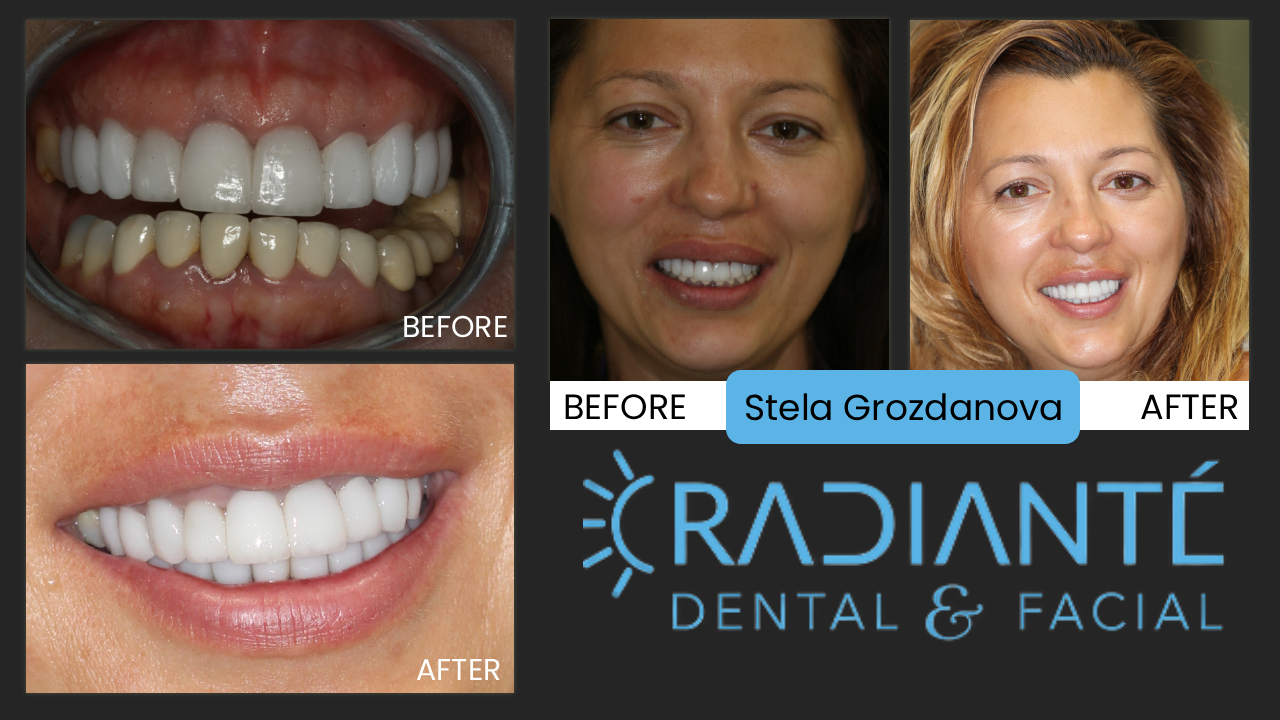 "I feel like a Hollywood star!"  Thank you so much for my beautiful smile.  I finally have the smile I want.  At Easter my whole family loved my smile and I had to give them all your phone number and address!"

Stela is a tall beautiful woman with kids now, but at one time she was a runway model.
Like many from Eastern Europe, however, she didn't have the nicest looking smile.
With a lot of unsightly old crowns that didn't do a good job of covering up the extensive dentistry under them.
So Stela had darkness around the margins of her crowns and small ill-formed teeth.
Stela has a lot of smile too showing a lot of teeth.  So we had our challenges to help her achieve a great smile.
We removed all the old dentistry, reconstructed her smile line with a gum lift and gave her new crowns
which were newer and whiter dental restorations that complimented her beauty rather than distracted from it.