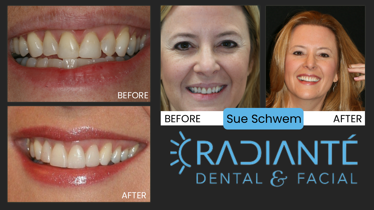 Sue represents a very special situation, She has involved in a terrible fall and her smile was almost irrepareably damaged. Once the healing starts, the journey starts to find a place that gives you back your smile. What kept her going? Her brother said "You'll come out of this with an even better smile then you had before."

What we Found: Several front teeth cracked right off. After emergency treatment  and stabilization on her vacation, Sue tentatively reached out to Dr. Ivan after a reecommendation from a friend. Sue had discovered what many others had found out before- unless your dentist spends alot of time rebuilding smiles, you can't count on the results. Her teeth felt "shaky" when biting her food. 

What we Did: Gum Lift, ReShape, Whiten and design A wonderful Smile.
The gum lift is gentle and easy and creates the proportion for shape and size. The All porcelain restorations are natural and strong.

Now, Sue can't stop smiling and neither can we.