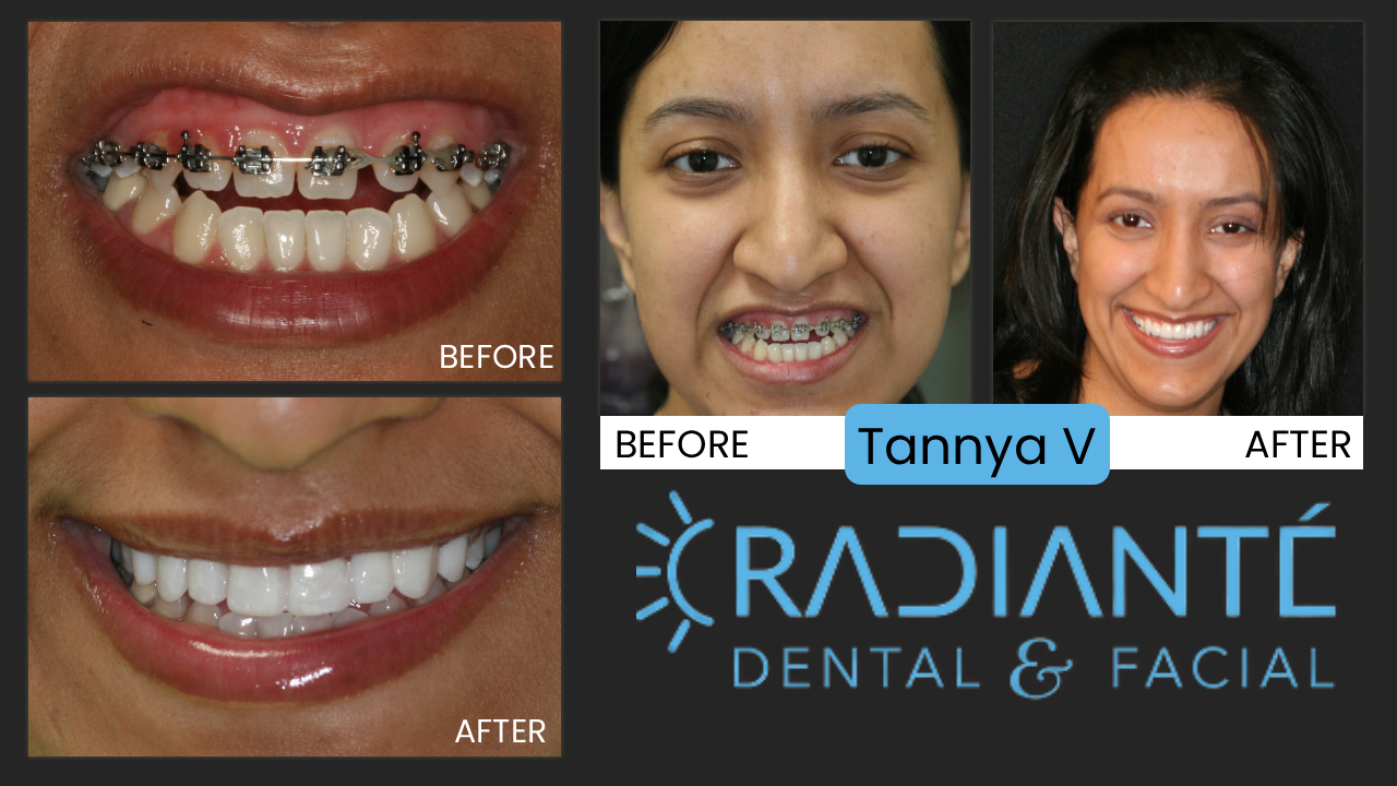 Tannya's story begins like so many.  She was actually accompanying her sister who had come to our office to improve her smile.  Perhaps because of all the photos displayed in our office, she realized her smile did not represent her as she would like. As a finance person in a bank, Tannya needed to look the part of a successful banker.  She felt her teeth did not allow her to look as presentable and professional as she needed. 

What we Found: Tannya started with  traditional orthodontic treatment, but became disenchanted as treatment was not improving her smile. She had an Open bite where the teeth did not touch when closed together. 
Her small, unnoticeable teeth that where becoming straighter but not . This is why we recommend seeing a cosmetic dentist prior to ANY treatment. Dr. Ivan can determine if your smile has the same problems Tannya's did when she undertook time-consuming treatment that would not give the results of an attractive smile.

What we Did: We needed to create more even spaces in her front teeth, so we worked until the spaces were more evenly distributed.  Then, a gum lift and beautiful porcelain veneers. This is the right treatment for Tannya to restore the fullness of her smile, the correct proportion in the tooth size and closed her open bite. 

The results are phenomenal.  Traditional orthodontic treatment, or surgery to correct her underbite would have been unnecessary pain and suffering and would have still left her with undersized teeth.  A cosmetic dentist is the right dentist to help Tannya have the smile of her dreams!She looks like the professional person that she is.