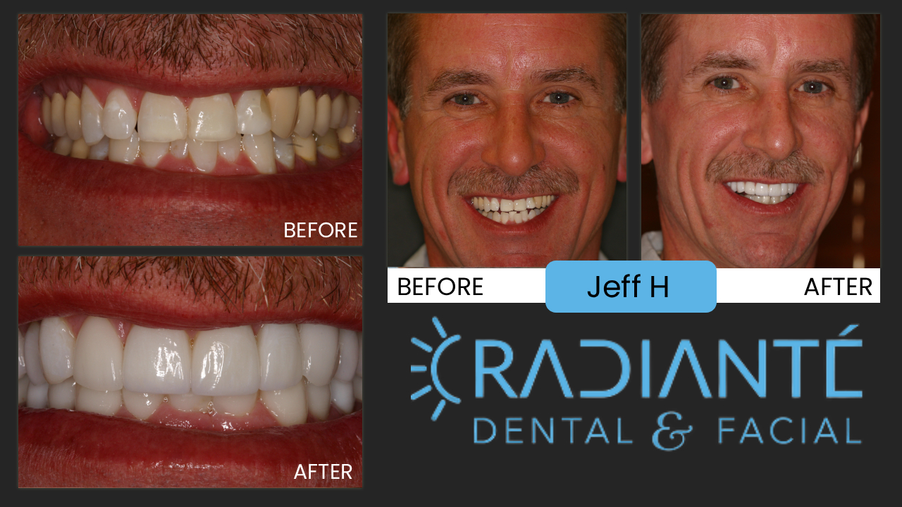 Jeff's story is not unlike a lot of people having divorced and looking for something that will make you look and feel your best when entering the dating world again and there's nothing like a successful guy that looks the part with a
really nice smile and younger looking whiter teeth!