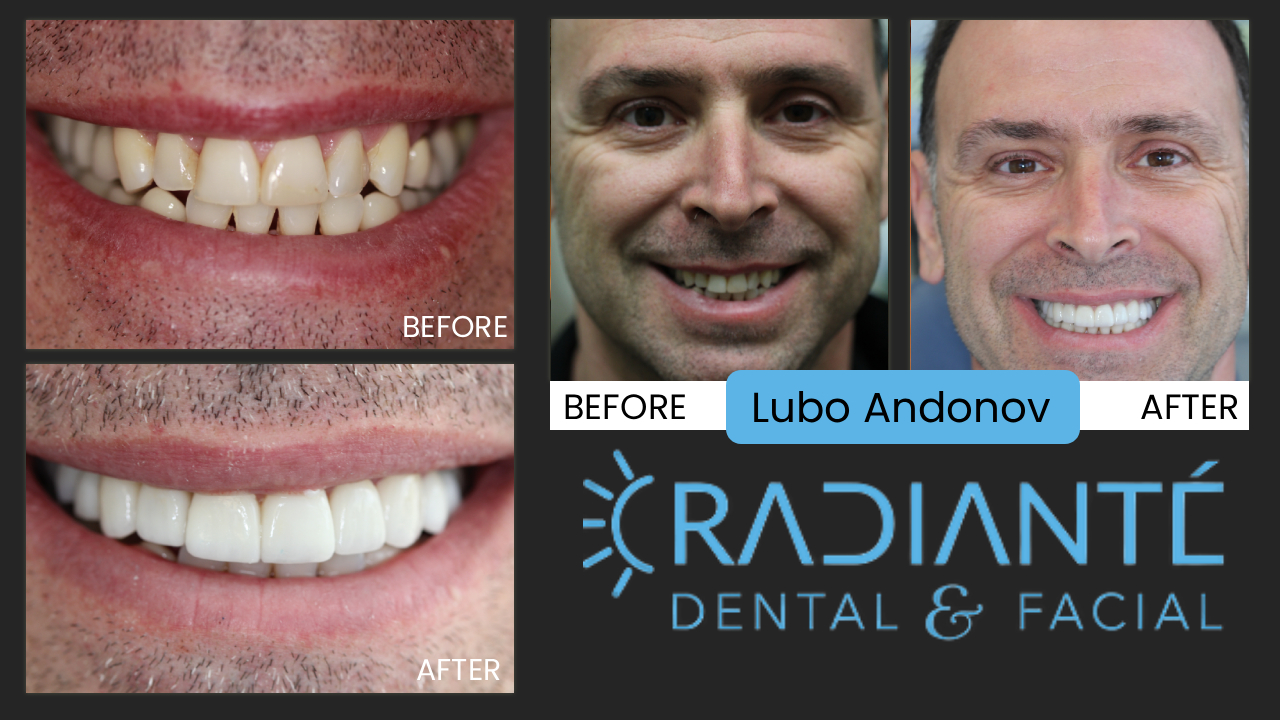 Lubo is a successful businessman and always felt a bit selfconscious of his less-than-perfect smile, but like a lot 
of people, he thought you had to live with what you had.  And even though his wife had been a clinical assistent to several dentists, it was not until she came to work at Radiante' and discovered the art and beauty and confidence 
Cosmetic Dentistry and Facial Esthetics can provide patients, did she realize what could be done for her own smile. Following the exceptional beauty of her new smile design and makeover, now Lubo wanted his smile improved. And what
a great result! He told us what we have heard so many times, that he now feels more proud, attractive and confident in a healthier, stronger, and attractive smile.