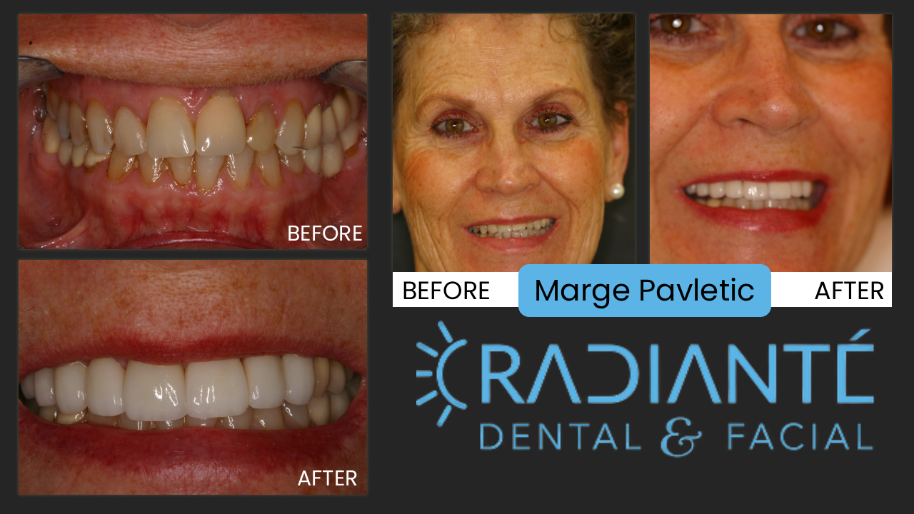 What she wanted:  I just adore Margi.  She's one of the kindest and nicest people you can ever meet.  Margi is beautiful and youthful.  She felt her smile was looking aged and worn.  Her loving husband of 50 years and three of her four children as dentists were all reticent to change her teeth.  This reluctance is natural, but Margi wanted it and so this loving family of dentists allowed Dr. Ivan to create a naturally beautiful smile.

What we did:  we paid particular attention to Margi's bite which placed abnormal pressures on her front teeth, and placed a variety of dental restorations, including crowns, and veneers on her front teeth to make them look newer and younger.

The results:  fantastic.  She has the smile which is the envy of her friends.  Her smile is more valuable than diamonds!  And thank goodness...Margi is my mother-in-law!!   Check our website to see the resemblance to our own beautiful, Dr. Kathy.