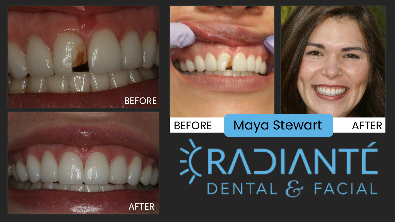 Maya had veneers done the year before but came to our office in tears that they just looked horrible.
Her veneers did not represent what she envisioned for her smile.  She wanted a beautifully natural looking smile but instead got very lifeless, unnatural, angled improperly, and very opaque, dull veneers. Unfortunately not all dentists are highly trained in the "golden proportion" in Cosmetic Dentistry and don't understand what materials and the type of dental materials
that should be used in particular and individual situations. Cosmetic Dentistry is difficult and takes time, training, skill,
and experience to do well. Maya now loves her smile and as a globetrekker, sometimes she will fly in from some exotic place just for us to check on her smile.