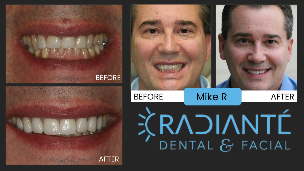 Mike had veneers on his teeth, but they were uneven, worn and his smile just wasn't beaming like it should.

Like we do with so many smile makeovers, we touched up his gums to make sure his smile was even and placed veneers

on all the teeth that were in his smile for a contiguous, even smile.  His confidence is soaring and loves his

Smile! "This is just what I was hoping for.  Thanks you do really good work, Dr. Ivan!"  Thank you, Mike!