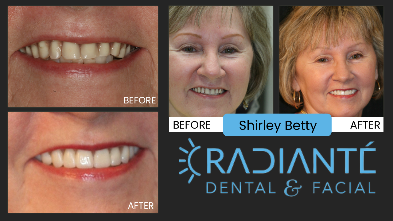 Shirley is a hip, with-it Grandma with a busy life with her husband, Roy, her daughter, granddaughter and dogs.

What We Found: A Smile that needs too many repairs to keep it going.

What We did: A new Smile- Freshened up. Whiter, Softer and healthy.
Confident and ageless beauty.  

Thanks Shirley, we loved helping you! Your zest for life comes through.