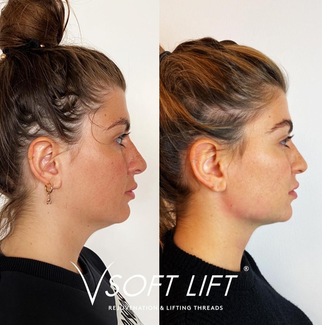 2 sessions of mono and 1 session lifting from Vsoftline